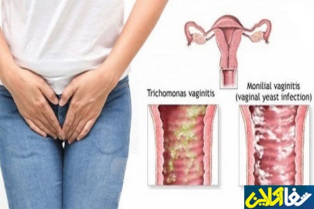 عفونت قارچی واژن در بارداری و تاثیر عفونت قارچی واژن بر جنین