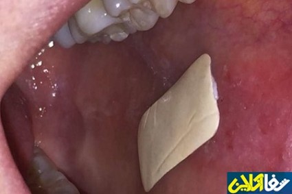 ابداع نوعی پچ برای درمان زخم‌های داخل دهان