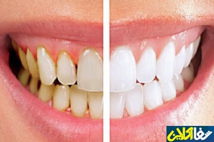 ۵ اشتباه رایجی که باعث زردی دندان‌ها می‌شود