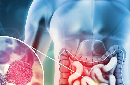 هر خون‌ریزی هموروئید نیست