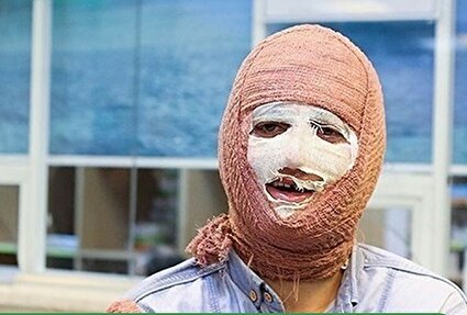 سوختگی در ایران، ۸ برابر بیشتر از میانگین جهانی