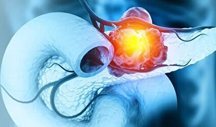 گامی بزرگ در درمان یکی از مرگبارترین سرطان‌ها