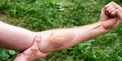 روش‌ ساده برای بهبود سریع‌تر کبودی پوست