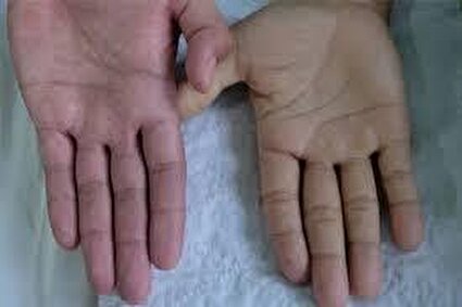 علائم اولیه کمبود آهن در بدن