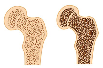 نقش الگو‌های غذایی در پیشگیری و کنترل پوکی استخوان