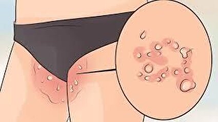 اچ پی وی در یک نگاه!/فیلم