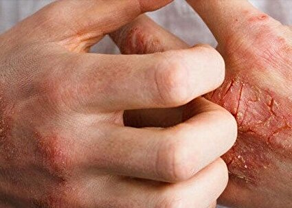 راهکارهای ساده برای کنترل اگزما