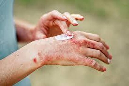 راهکارهای ساده برای کنترل اگزما