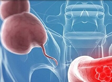 سرطانی که با تغییر اجابت مزاج خود را نشان می‌دهد