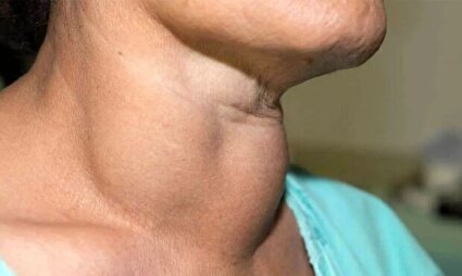 تیروئید شما در خطر است / سرطان ممکن است خاموش رشد کند !