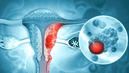 زمان ابتلا به سرطان دهانه رحم