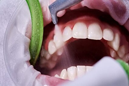 راهی موثر برای پیشگیری از پوسیدگی و بیماری لثه