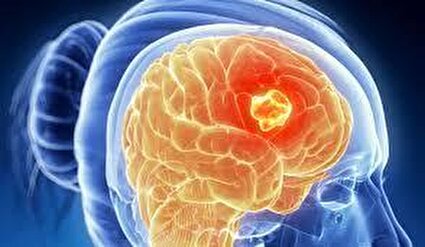 چه کسانی بیشتر در معرض خطر تومورهای مغزی هستند