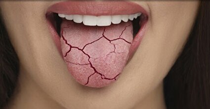 ۱۰ راه ساده برای رهایی از خشکی دهان