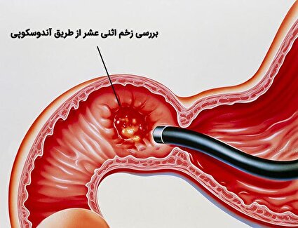 آندوسکوپی زخم گوارشی/فیلم