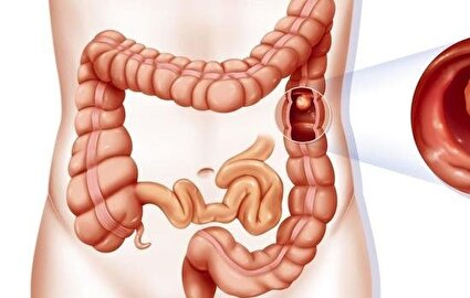اختلال روده ی نشت کننده و بیماریهای خودایمنی