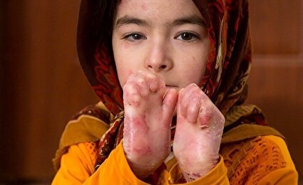 پانسمان‌های تخصصی بیماران پروانه ای تحویل شد