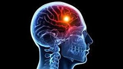 سکته مغزی ۱۴۰ هزار ایرانی در سال
