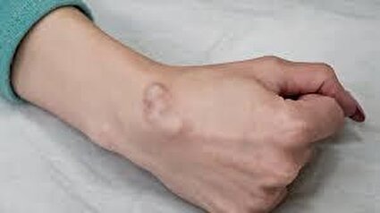 علت ایجاد کیست گانگلیون در مچ دست