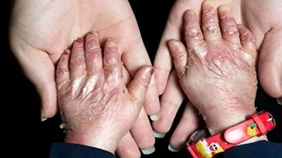 هزینه پانسمان ماهانه تا ۳۰ میلیون تومان