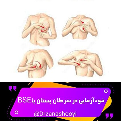 خودآزمایی در سرطان پستان یاBSE