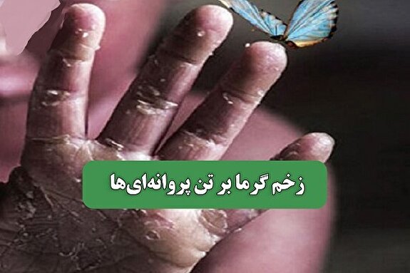 زخم گرما بر تن پروانه‌ای‌ها