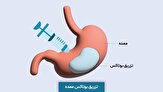 بوتاکس معده؛ معجزه لاغری یا فریب موقت؟