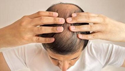 ارتباط داروی رایج ضد ریزش مو با ریسک افسردگی و خودکشی