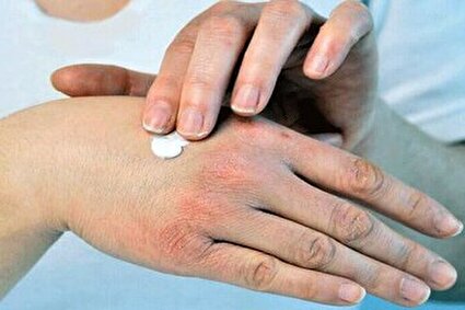 راهکارهای ساده برای جلوگیری از خشکی پوست