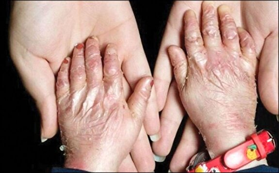 پانسمان حیاتی بیماران پروانه‌ای در فهرست تحریم‌هاست