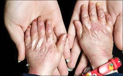 پانسمان حیاتی بیماران پروانه‌ای در فهرست تحریم‌هاست