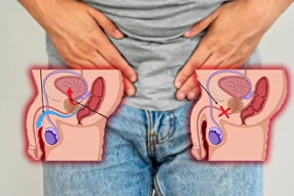 انزال معکوس یا رتروگراد چه تأثیری بر ناباروری مردان دارد؟