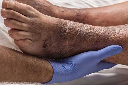 چند درصد دیابتی‌ها گرفتار زخم می‌شوند؟