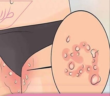 شیوع زگیل تناسلی در دختران و پسران نوجوان