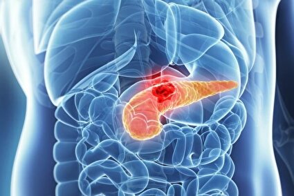 شناسایی علامت هشدار دهنده اولیه سرطان معروف به «قاتل خاموش»