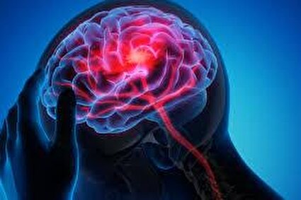 سکته مغزی دومین عامل مرگ‌ و میر در جهان