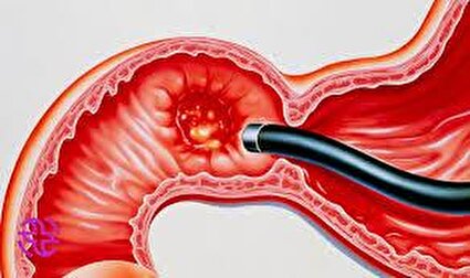 آندوسکوپی زخم گوارشی/فیلم