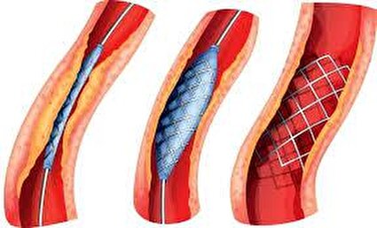 آنژیوپلاستی یا فنر گذاشتن در رگ های قلب/فیلم