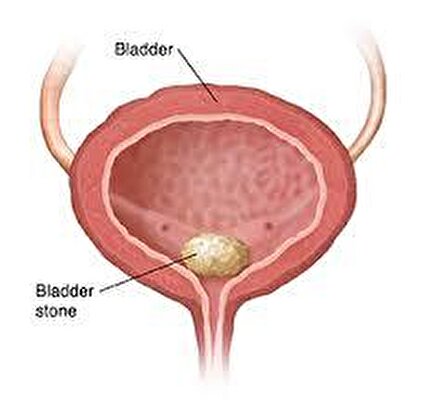 خارج کردن سنگ مثانه/فیلم