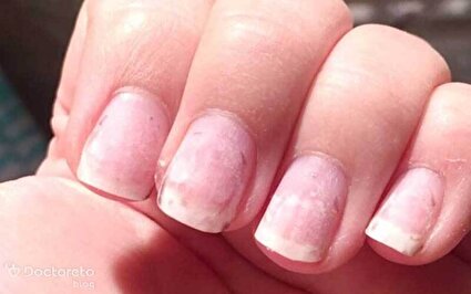 کاشت ناخن و عفونت استخوان!/فیلم