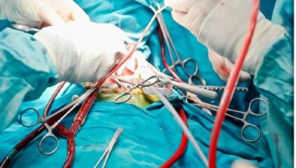 جهان، در آستانه انجام اولین پیوند قلب
